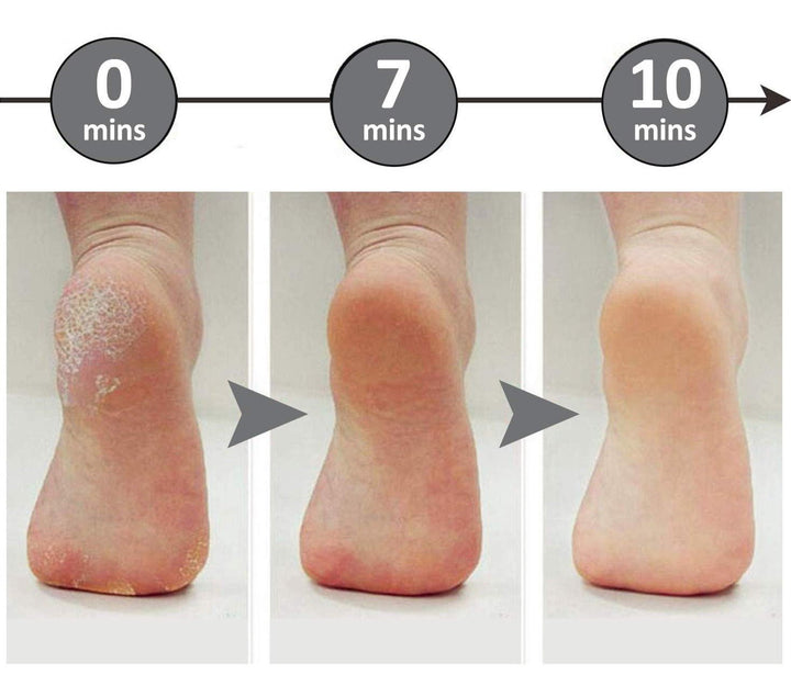 Mevor | Callus Removers - kompakt und sicher - schmerzlose Genesung-3